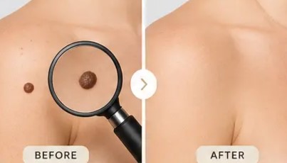 Xal müalicəsi — Dermatoloq Dr. Mehdi Mahmudi