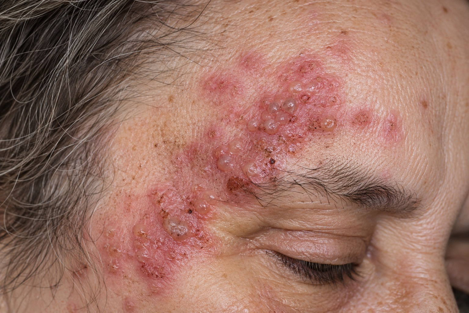 Varicella zoster virusunun sinir boyunca aktivləşməsi