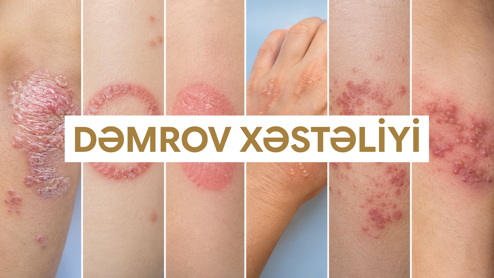 Dəmrov n&ouml;vlərinin m&uuml;qayisəli g&ouml;r&uuml;n&uuml;ş&uuml; - psoriaz, ekzema, tinea, zona