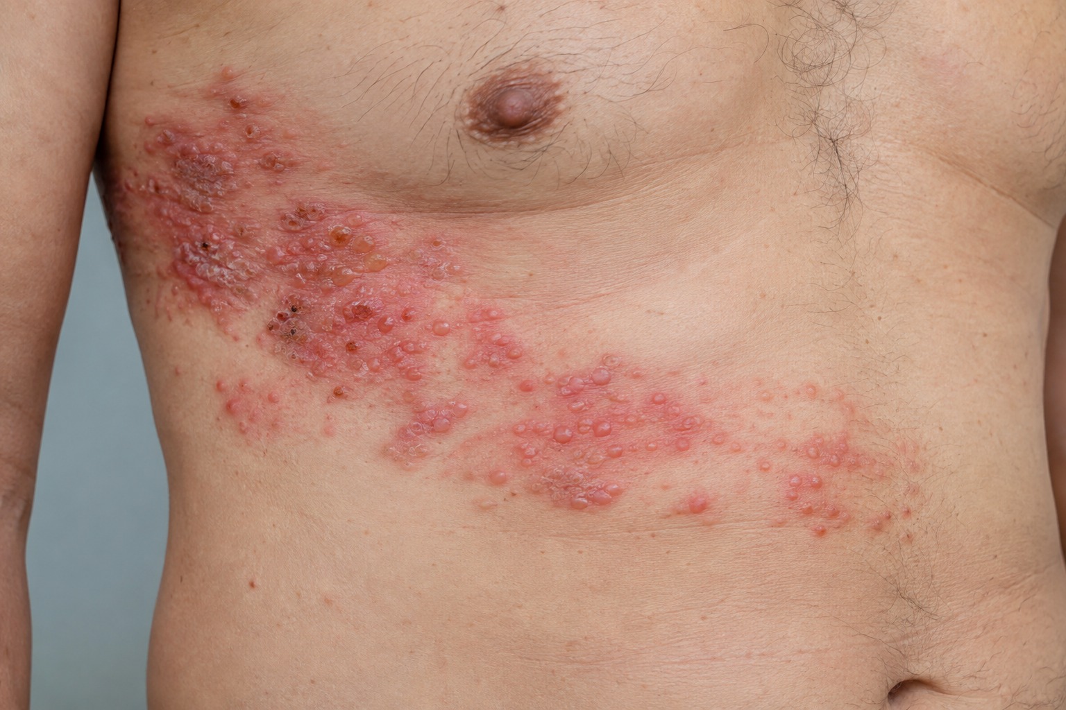 Herpes Zoster zamanı dəridə yaranan səpkilər