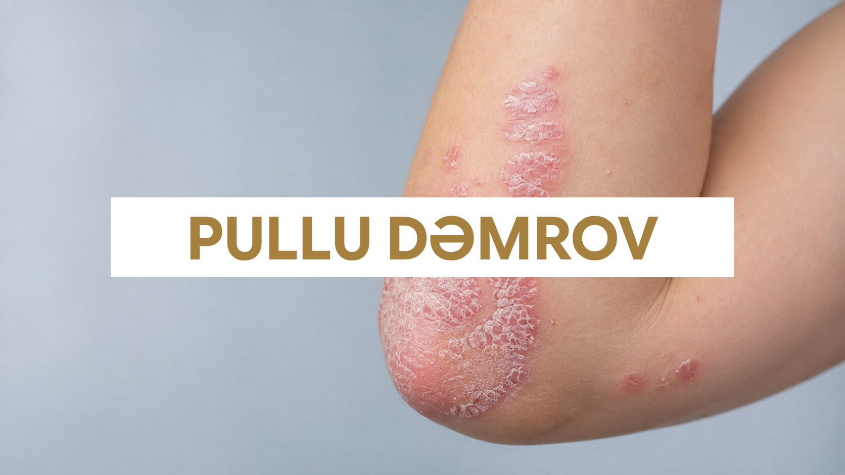 Pullu dəmrov - dirsəkdə g&uuml;m&uuml;ş&uuml; pulcuqlu psoriaz plaqları