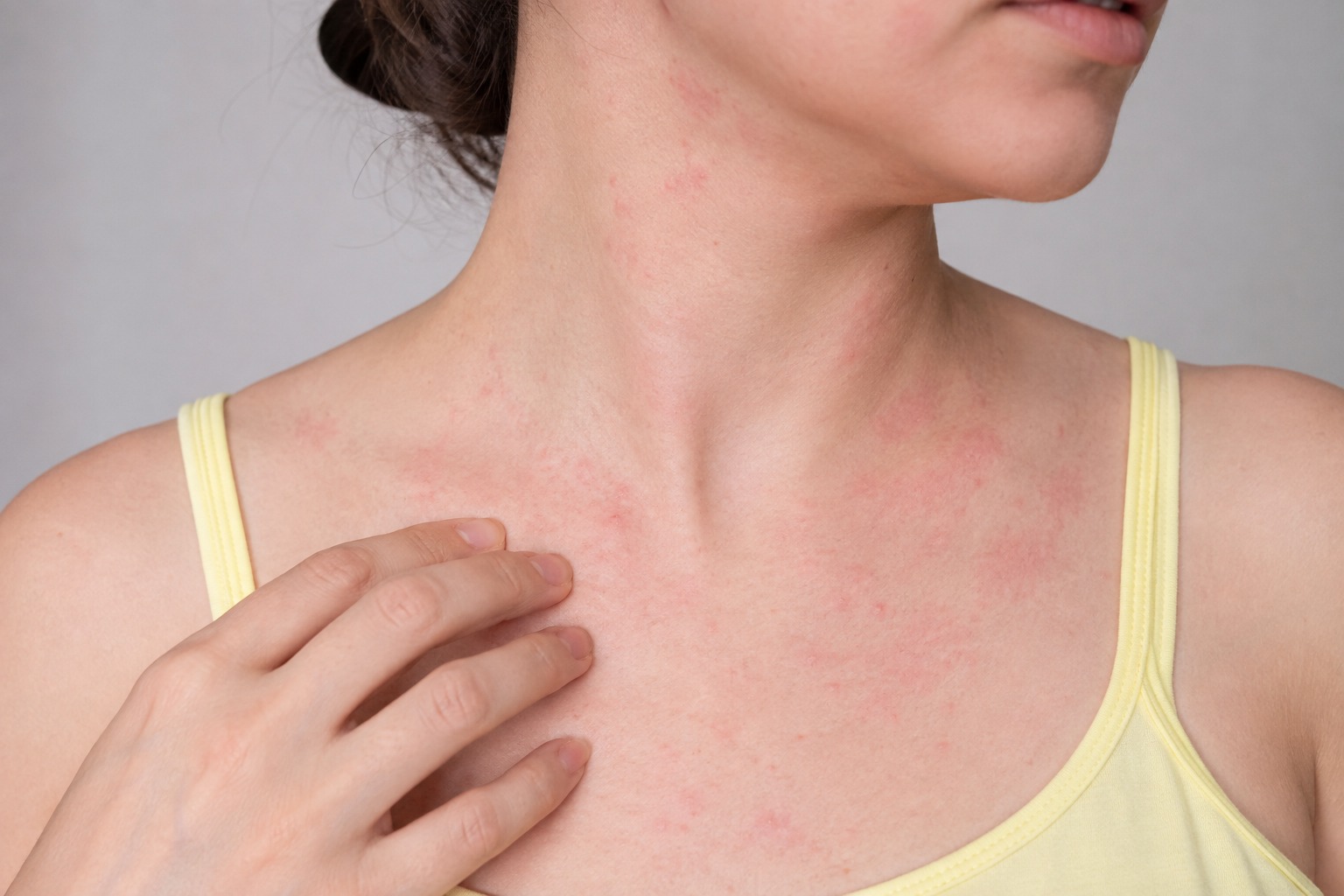 Augmentin allergiyası və antibiotikdən sonra dəri səpgisi.jpeg