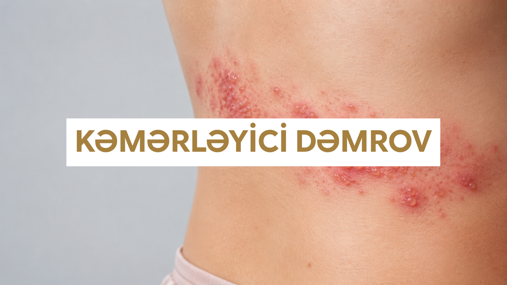 Kəmərləyici dəmrov - bel nahiyəsində bir tərəfli zona səpgisi