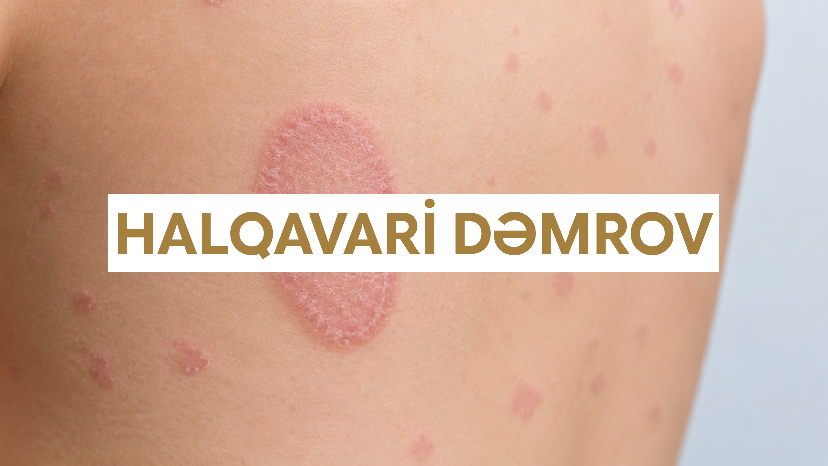 Halqavari dəmrov - g&ouml;vdədə kənarı qabarıq halqa formalı tinea corporis ocağı