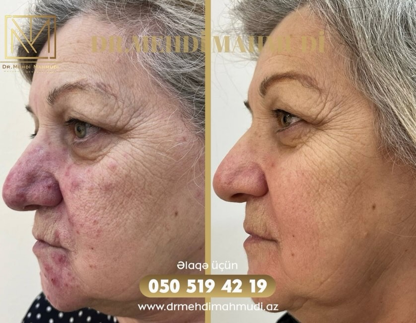 rozasea before after.jpg