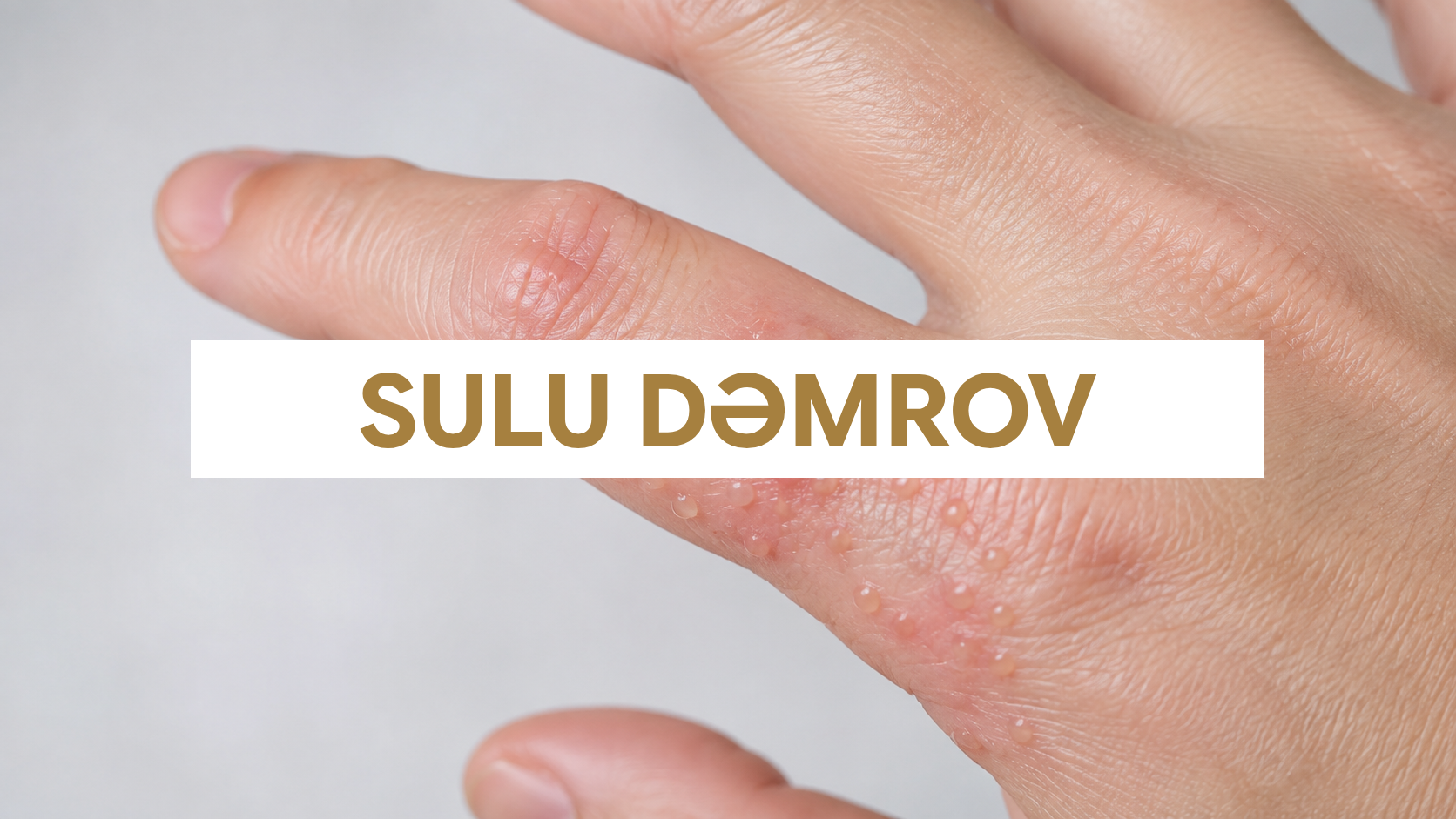 Sulu dəmrov - barmaqlarda dishidrotik ekzema qabarcıqları
