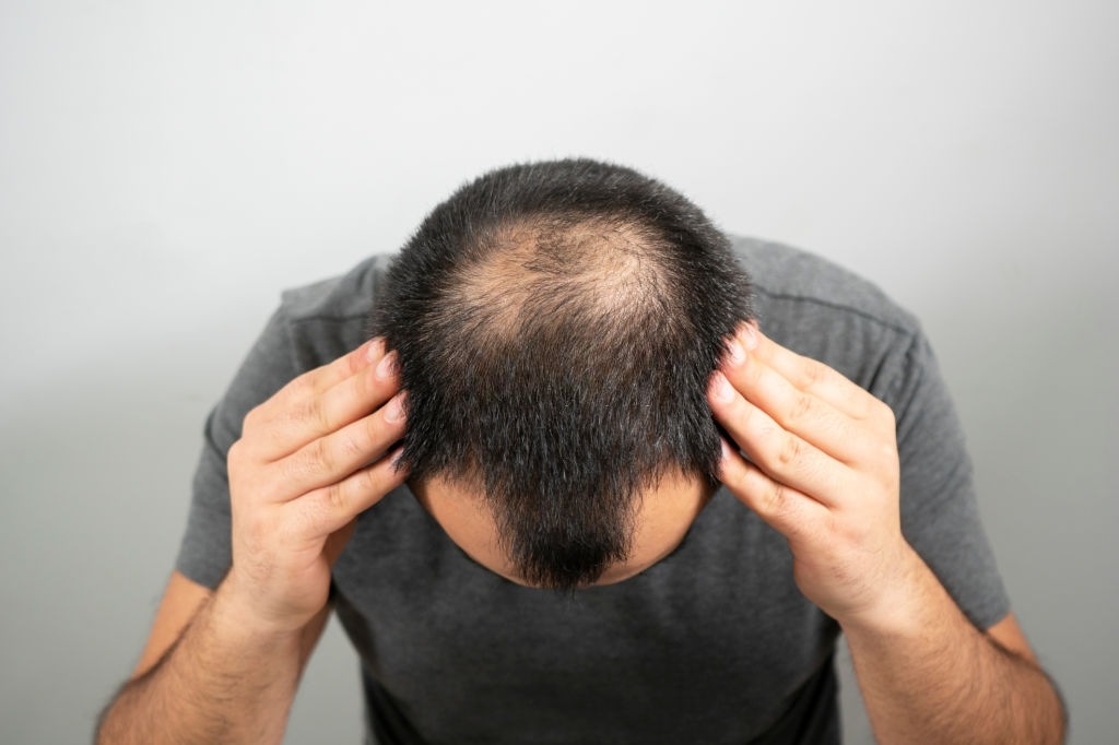 Saç tökülməsi - səbəbləri və müalicəsi | drmehdimahmudi.az