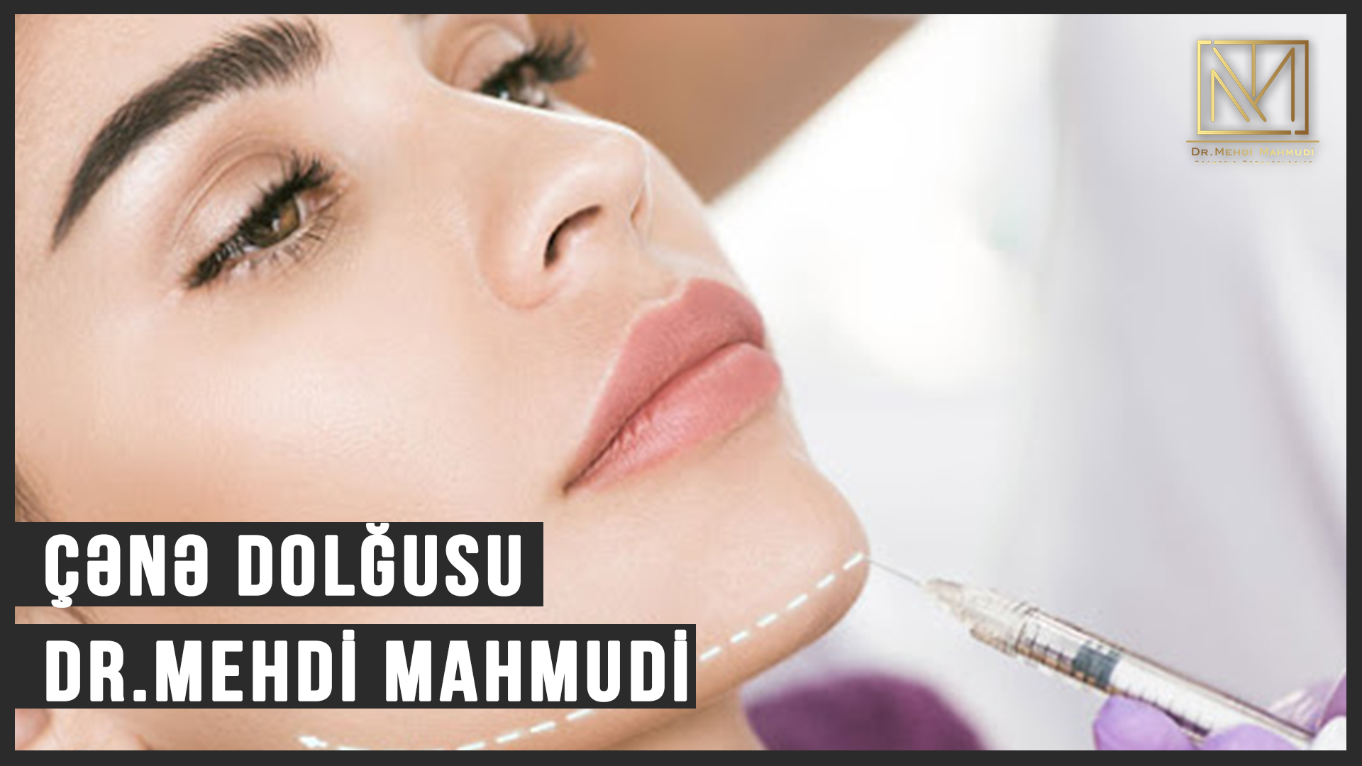 Çənə Dolğusu - Dr.Mehdi Mahmudi #esteticdermatolog