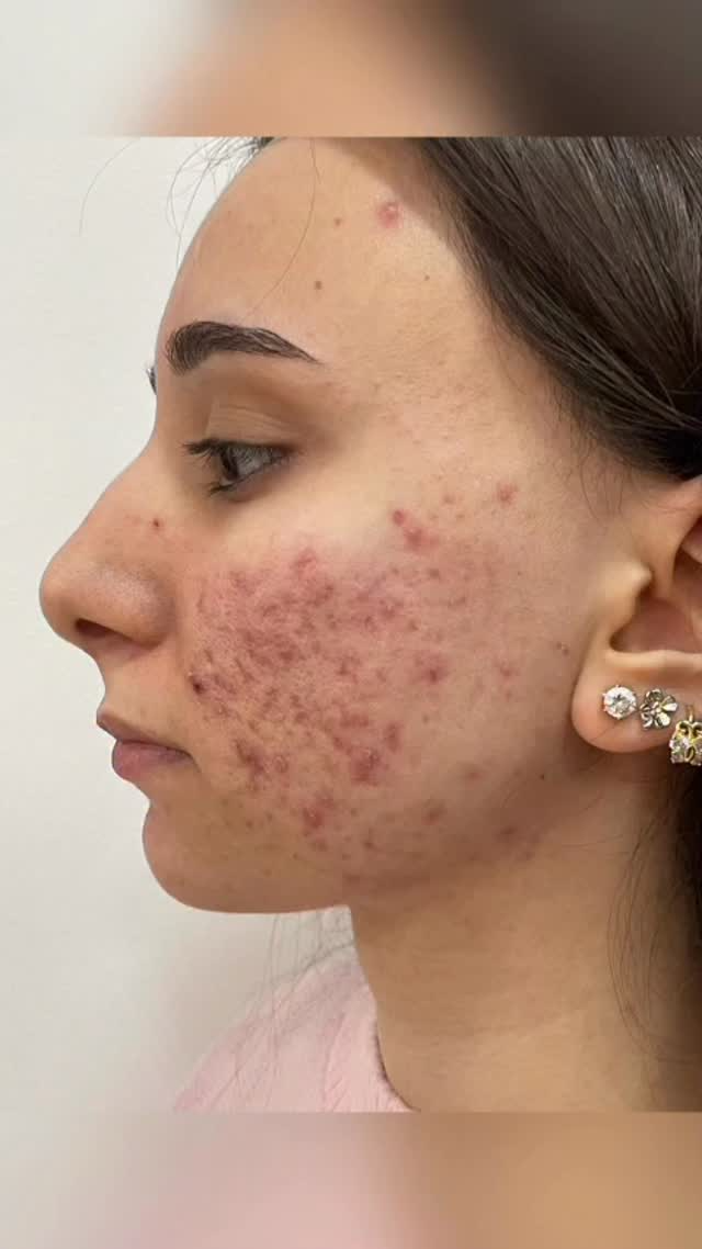 Akne Müalicəsi - Sızanaq Müalicəsi