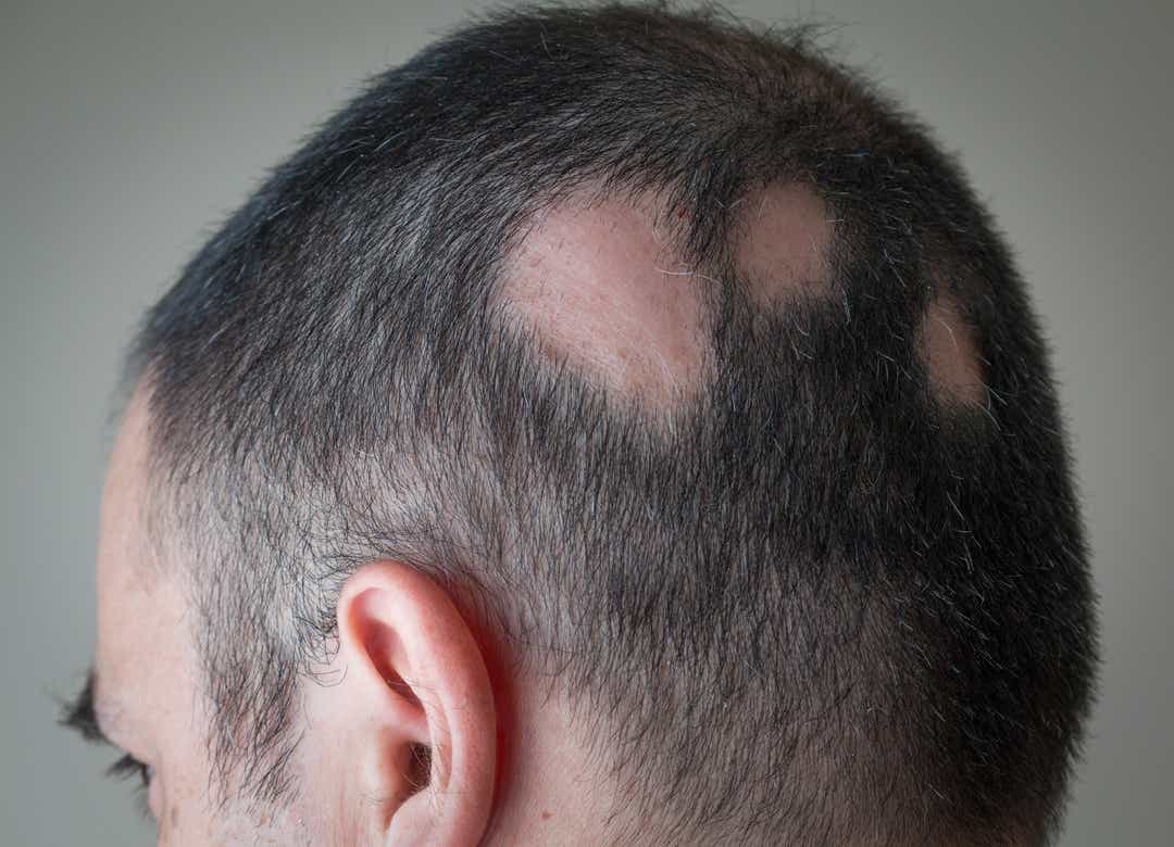 Alopesiya Areata necə müalicə olunur? Saç Tökülmə