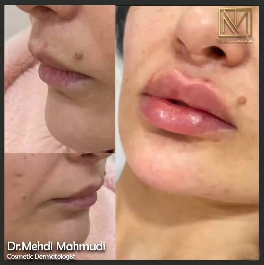 Dodaq Dolğusu nəticələri — Dr. Mehdi Mahmudi